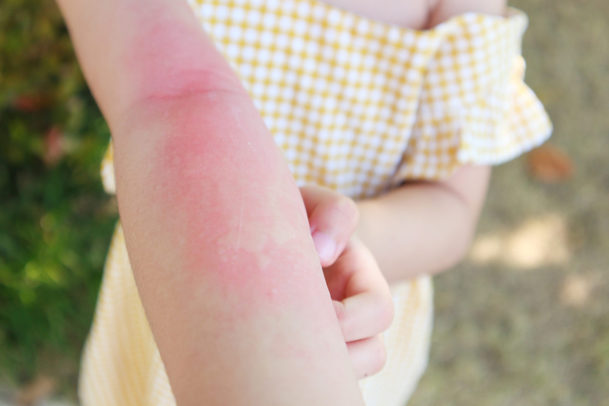 Skin manifestations in children with food allergy