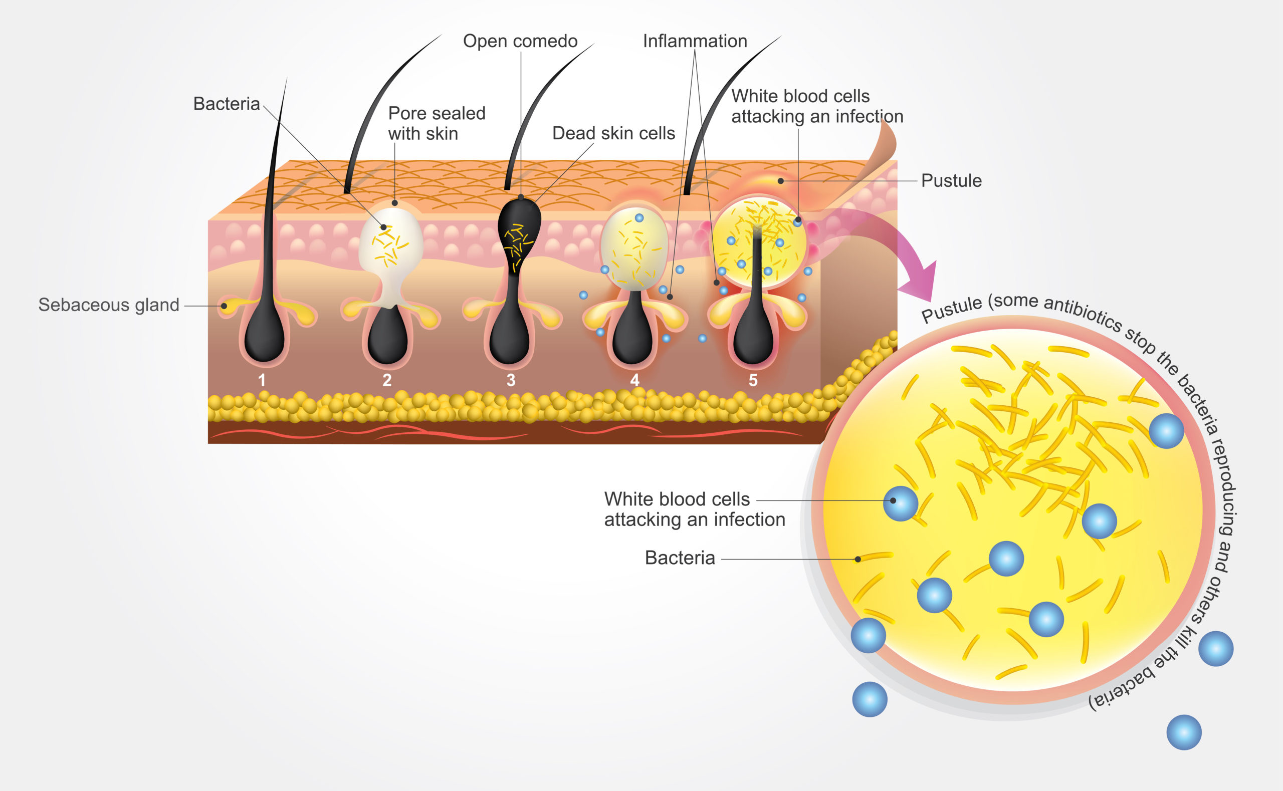 Mechanism of acne formation due to bacteria